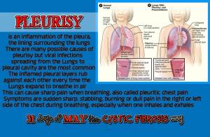 day 14 pleuisy